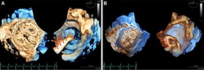 Advancing paediatric cardiac imaging: a comprehensive analysis of the feasibility and accuracy of a novel 3D paediatric transoesophageal probe